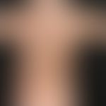 Nummuläre Dermatitis:&nbsp; Übersichtsaufnahme: Scharf begrenzte, 2-6 cm große, entzündlich geröt...
