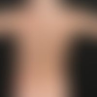 Nummular dermatitis: General view: Sharply defined, 2-6 cm large, inflammatory reddened, coin-sha...