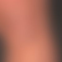 Psoriasis vulgaris chronisch-stationäre (Plaque-Typ):&nbsp;Seit mehreren Jahren bestehende, wenig...