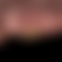 Verrucous carcinoma (Carcinoma cuniculatum): Slowly growing, moderately exophytic, wart-like tumo...