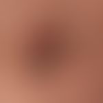 Brown-black papules and nodes (clinical diagnosis: Verrucae seborrhoicae in different stages of d...