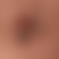 Brown-black papules and nodes (clinical diagnosis: Verrucae seborrhoicae in different stages of d...