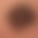 Nodules: Keratosis seborrhoeic. for several years, slowly growing, broadly basal, completely symp...