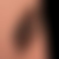 Keratose seborhoische: Seit Jahren bestehender, langsam wachsender, breitbasig aufsitzender, brau...