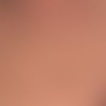 Keratose seborrhoische (papillomatöser Typ):&nbsp;&nbsp;Seborrnoische Keratosen in unterschiedlic...
