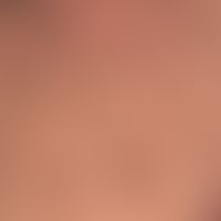 Keratose seborrhoische (papillomatöser Typ):&nbsp;&nbsp;Seborrnoische Keratosen in unterschiedlic...