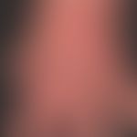 Erysipelas, recurrent with pronounced lymphedema of the back of the hand, condition after lymphad...