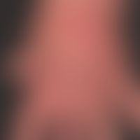 Erysipelas, recurrent with pronounced lymphedema of the back of the hand, condition after lymphad...