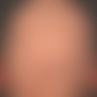 Alopecia areata (Grade 2-3): extensive loss of hair in the capillitium. at higher magnification, ...