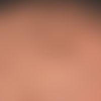 Alopecia areata (Grade 2-3): extensive loss of hair in the capillitium. at higher magnification, ...