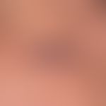 Keratocanthoma centrifugum marginatum: Plattenartiges&nbsp;zentral ulzeriertes Riesenkeratoakanth...