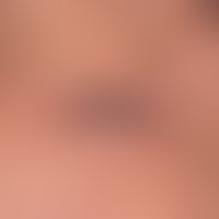Keratocanthoma centrifugum marginatum: Plate-like, centrally ulcerated giant keratoakanthoma over...
