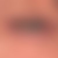 Keratocanthoma centrifugum marginatum: Detailaufnahme mit den typischen Merkmalen des Keratoakath...
