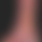 Ulcus cruris venosum. CVI with recurrent ulcer formation, known for years. multicentric, chronic,...