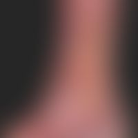 Ulcus cruris venosum. CVI with recurrent ulcer formation, known for years. multicentric, chronic,...
