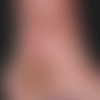 Ulcus cruris mixtum. solitary, chronic, since 2 years existing, sharply defined, smeary-coated, y...