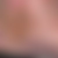 Corona phlebectatica. 63 Jahre alte Patientin mit bekannter CVI. Ausgeprägte retikuläre Varizenbi...