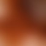 Melanom malignes:&nbsp;Auflichtmikroskopie. Pfeile: amelanotische Tumorproliferate mit bizarren "...