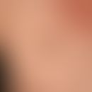 Melanoma malignes: slowly growing, completely weightless, brown spot, existing for years. 6 month...