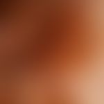 Melanom malignes&nbsp;(Auflichtmikroskopie, klin. Abb. s. zuvor): Eingekreist noch "physiologisch...