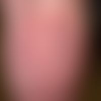 tinea cruris. large-area mishandled tinea. mycological-cultural evidence by pretreatment multiple...