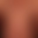 Melanoerythrodermie:&nbsp;Diffuse, ätiologisch ungeklärte Braunverfärbung des gesamten Integument...