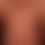 Melanoerythrodermie:&nbsp;Diffuse, ätiologisch ungeklärte Braun(rot-)verfärbung des gesamten Inte...