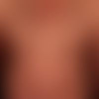 Melanoerythroderma: Diffuse, etiologically unexplained brown (red) discoloration of the entire in...