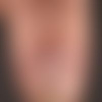 Glomustumor.&nbsp;Bläulich-roter, subungual gelegener&nbsp;Glomustumor mit typischer einschießend...