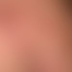Zoster ophthalmicus:&nbsp;wenige Tage alter Zoster ophthamicus.&nbsp;&nbsp;Eingekreist 1-2Tage al...