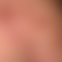 Zoster ophthalmicus:&nbsp;wenige Tage alter Zoster ophthamicus.&nbsp;&nbsp;Eingekreist 1-2Tage al...