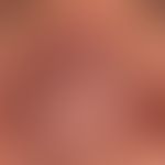 diffuse rhinophyma: distinct uniform shape disorder of the nose due to diffuse phymogenesis in a ...