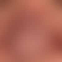 diffuse rhinophyma: distinct uniform shape disorder of the nose due to diffuse phymogenesis in a ...