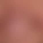 Diffuse rhinophyma: distinct uniform disturbance of the shape of the nose due to diffuse phymogen...