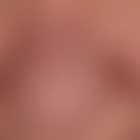 Diffuse rhinophyma: distinct uniform disturbance of the shape of the nose due to diffuse phymogen...