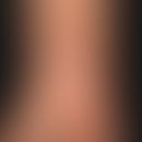 Lichen planus verrucosus. 1 year old, constantly itchy, blurred, firm plaque with a wart-like sur...