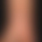 Lichen planus verrucosus. 1 year old, constantly itchy, blurred, firm plaque with a wart-like sur...