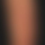 Lichen planus verrucosus: extensive, blurred, chronically stationary, coarse, brownish-red, rough...