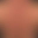 Scleroedema adultorum:&nbsp;seit &nbsp;mehreren Jahren bestehende, mit zunehmender Steifigkeit ei...