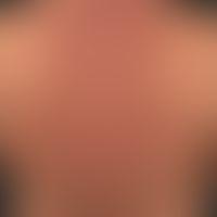 Scleroedema adultorum:&nbsp;seit &nbsp;mehreren Jahren bestehende, mit zunehmender Steifigkeit ei...