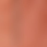 Leiomyoma (marginal area): Missing follicular structure in lesional skin (right marked side); lef...