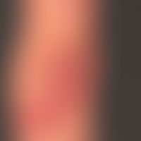 Chronisch aktive Psoriasis:&nbsp;typisches Befallsmuster. Psoriatische Plaques mit geringer sicht...