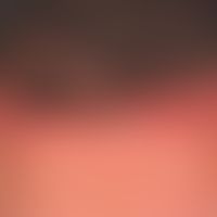 Chronic stationary psoriasis: typical pattern of infection on the capilliium with spread of psori...