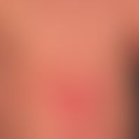 Psoriasis vulgaris. chronic active psoriasis. overview: multiple, erythematous, little scaly (pre...