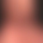 Acrodermatitis chronica atrophicans. general view: livid, unscnarf limited, brownish-red spots on...
