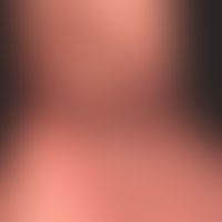 Acrodermatitis chronica atrophicans.&nbsp;Übersichtsaufnahme: Livide, unscnarf&nbsp;begrenzte, br...