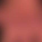 Acrodermatitis chronica atrophicans. detail view: livid, unscnarfly limited, changeably coloured ...