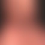 Acrodermatitis chronica atrophicans. encircles the protruding atropical skin in the area of the b...