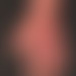 Acrodermatitis chronica atrophicans. general view: Livid, unscnarfly limited, changeably coloured...