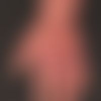 Acrodermatitis chronica atrophicans.&nbsp;Übersichtsaufnahme: Livide, unscnarf begrenzte, wechsel...